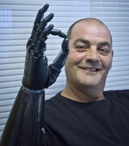 Nigel Ackland, bebionic myoelectric hand, prosthetic